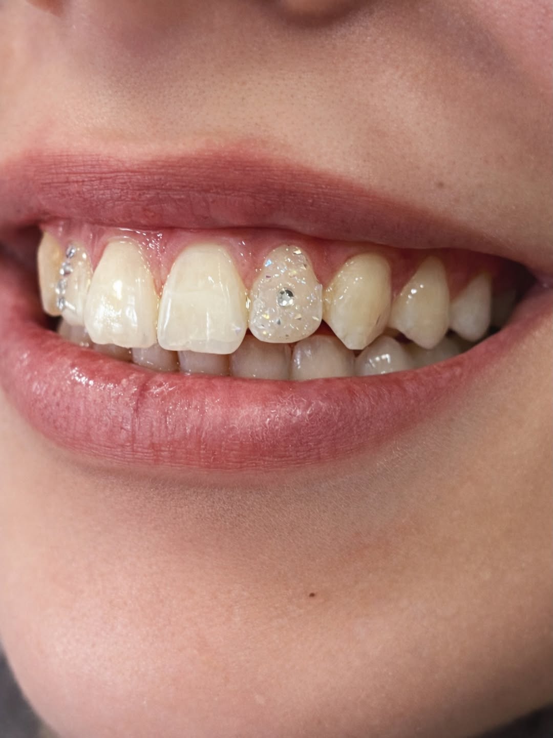 Tooth gems — šperky na zubech