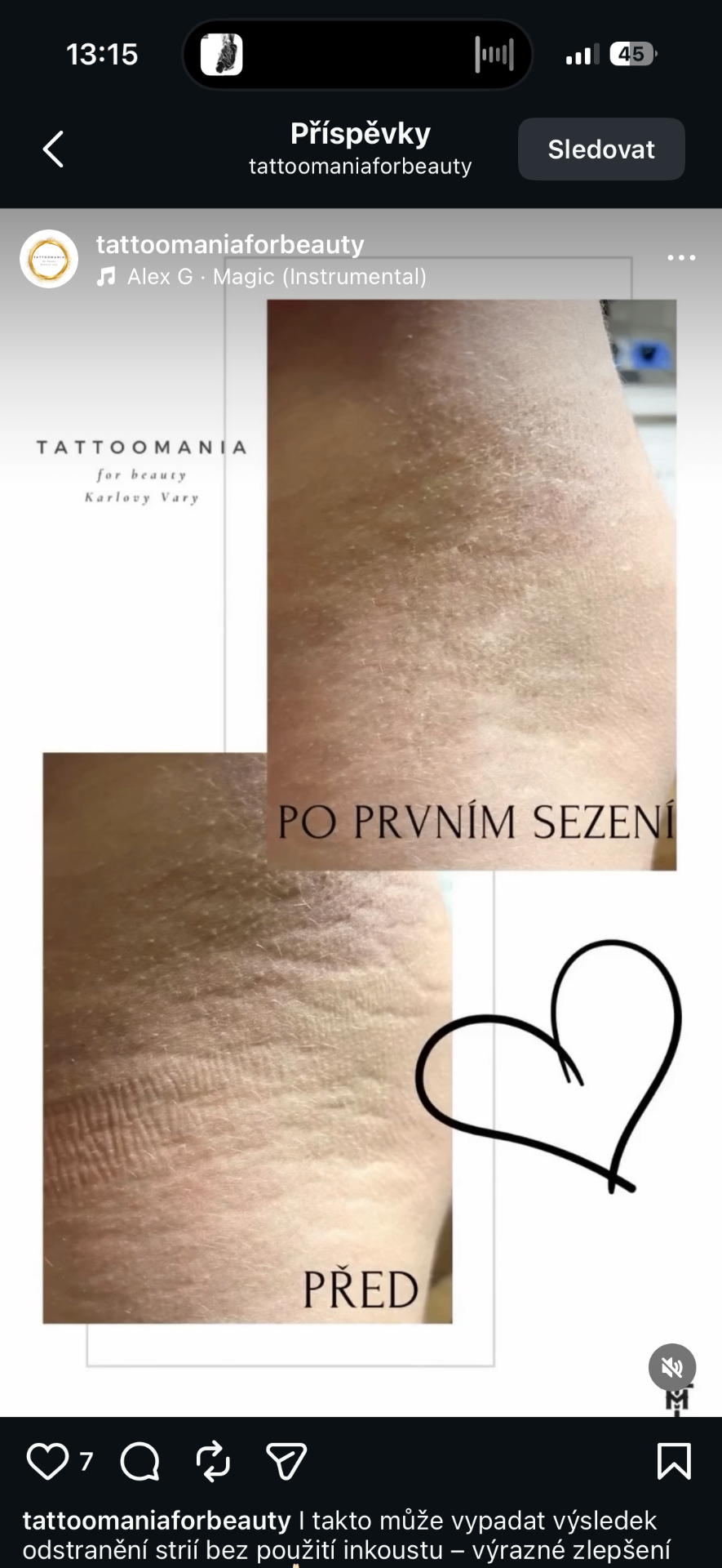 Odstranění strií sérem — výsledek po prvním sezení