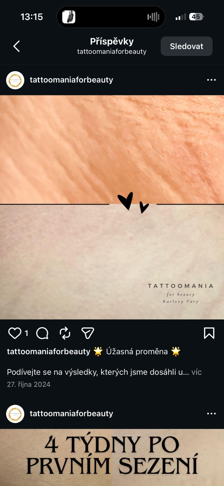 Odstranění strií sérem — proměna pokožky